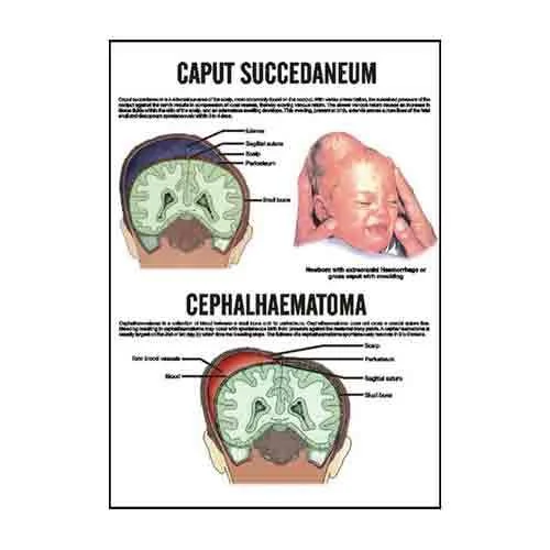 INC14  Caput Succedaneum Cephalhaematoma