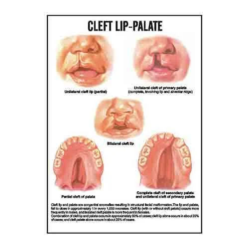 INC16  Cleft lip-Palate