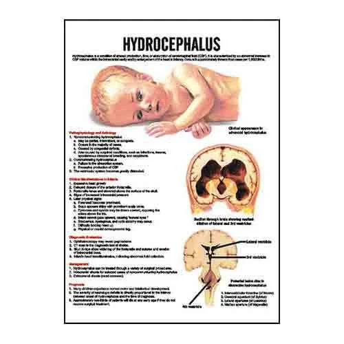 INC18 Hydrocephalus