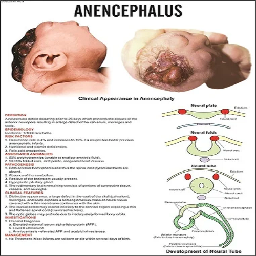 INC19 Anencephalus