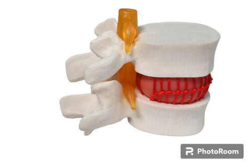 Disc Prolapse Simulator Model