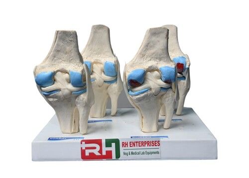 4 Stage Arthritis knee model