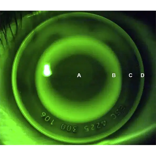 Orthokeratology Lens