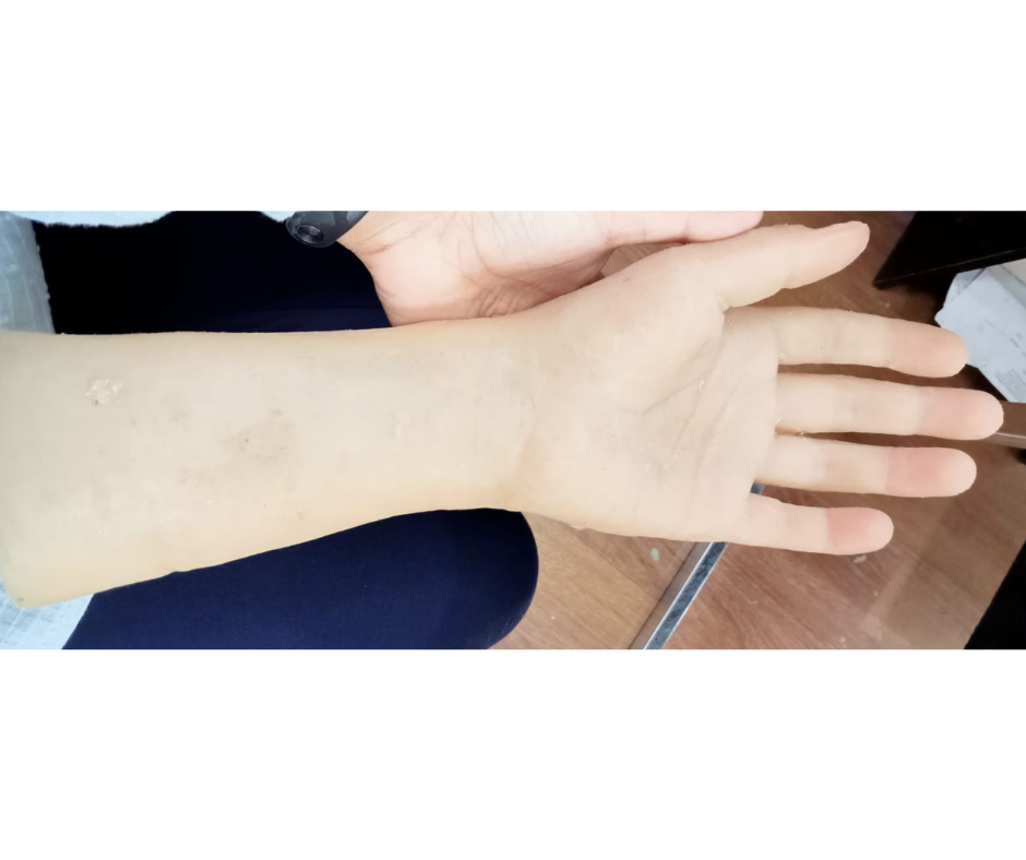 Rebuilt Silicone Hand Prosthesis