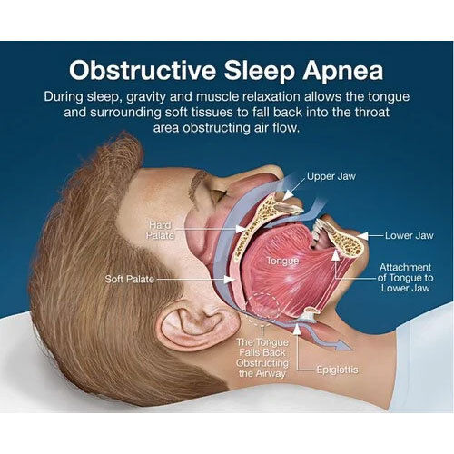 OSA - Obstructive Sleep Apnea