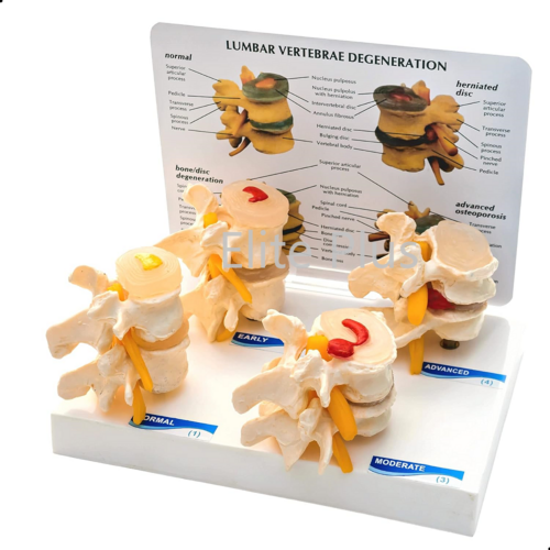 ZX-1505 Lumbar Vertebrae Degeneration Model