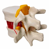 ZX-1504 Functioning Prolapsed Lumbar Vertebrae Model