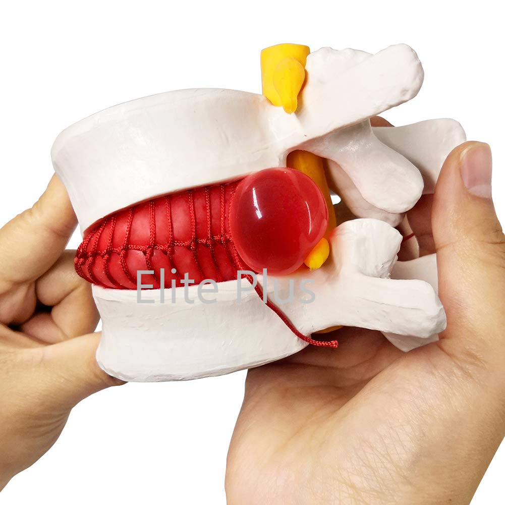 ZX-1504 Functioning Prolapsed Lumbar Vertebrae Model