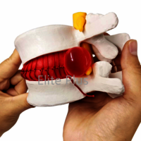 ZX-1504 Functioning Prolapsed Lumbar Vertebrae Model