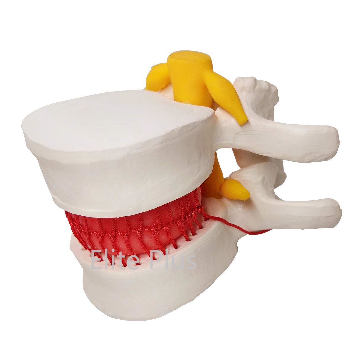 ZX-1504 Functioning Prolapsed Lumbar Vertebrae Model