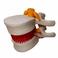 ZX-1504 Functioning Prolapsed Lumbar Vertebrae Model