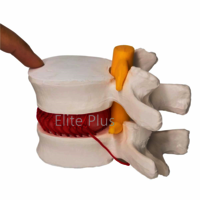 ZX-1504 Functioning Prolapsed Lumbar Vertebrae Model