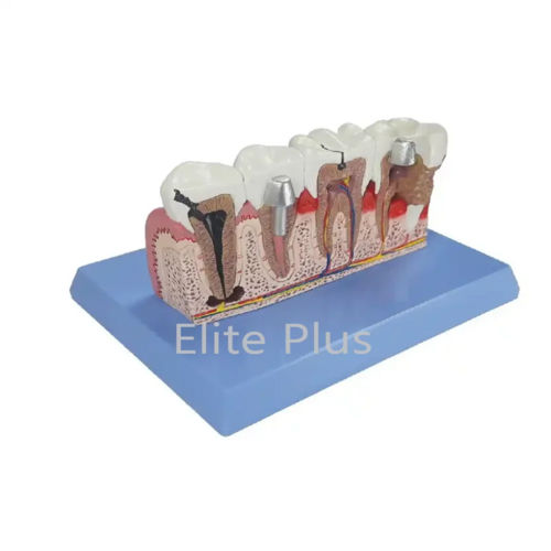 ZX-1506P Teeth Pathologies