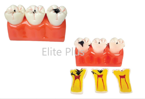 ZX-1512P Dental Caries Model