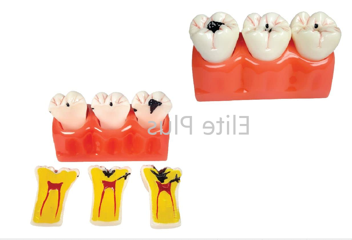 ZX-1512P Dental Caries Model