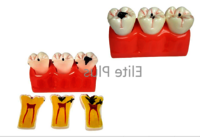 ZX-1512P Dental Caries Model