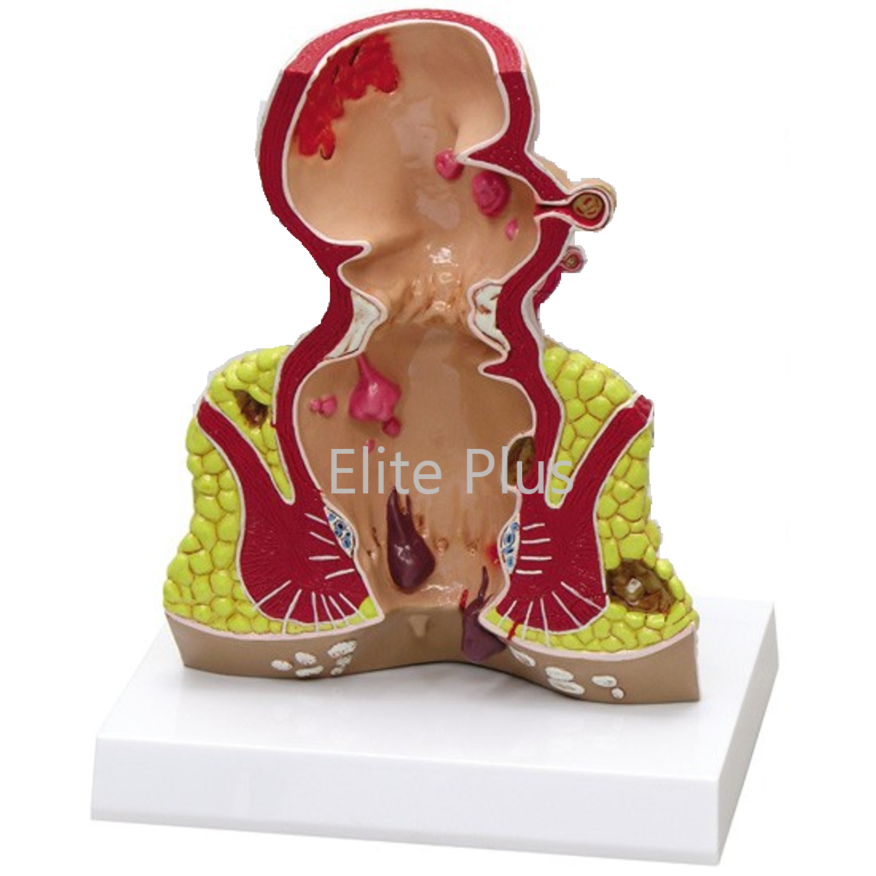 ZX-1514P Rectum Pathologies Model