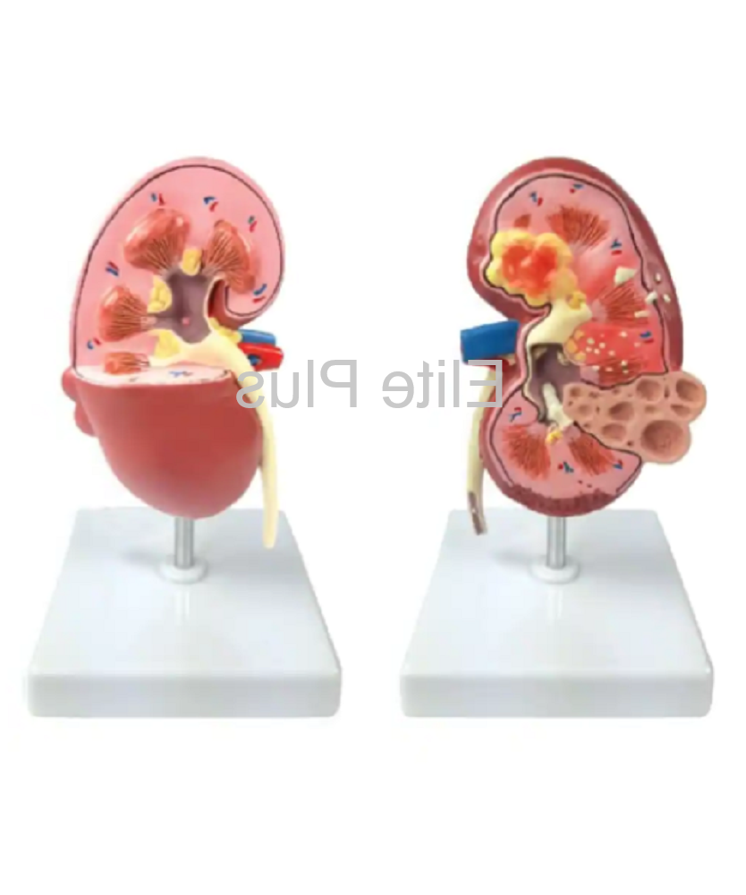 ZX-1513P Kidney Pathologies Model