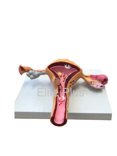 ZX-1516P Uerus & Ovary Pathalogies Model