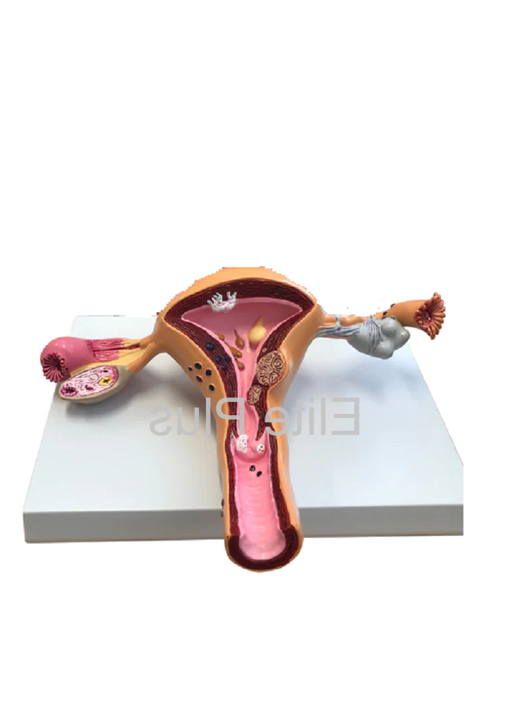 ZX-1516P Uerus & Ovary Pathalogies Model