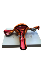 ZX-1516P Uerus & Ovary Pathalogies Model