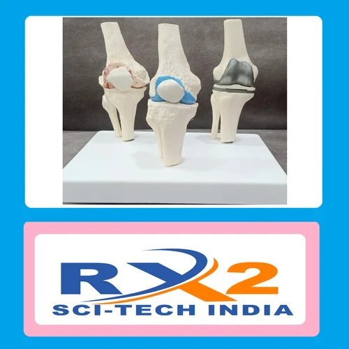 Arthritis Knee Model with Implant