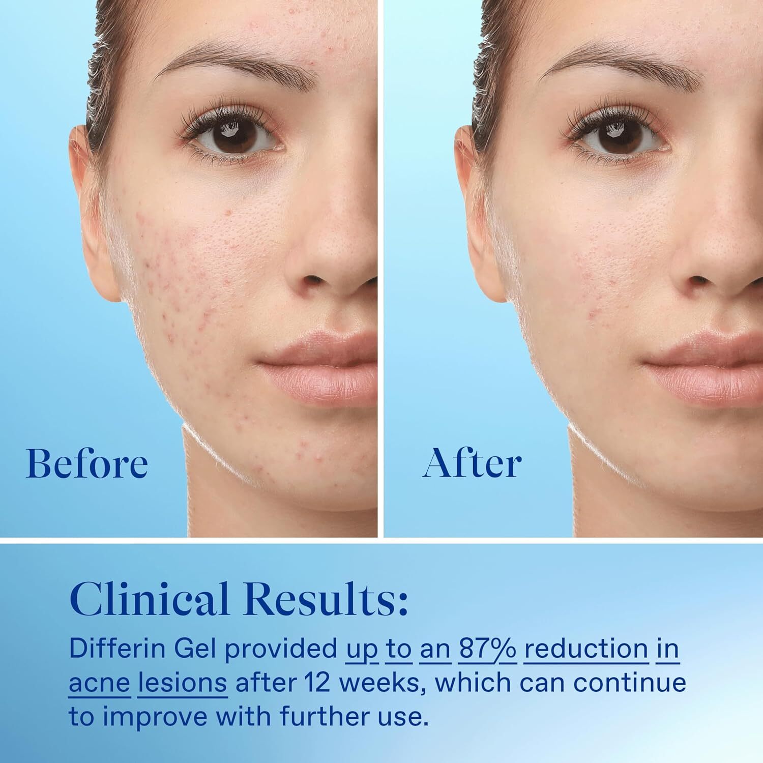 Differin Acne Treatment Gel, 90 Day Supply, 0.1% Adapalene, 45g Pump