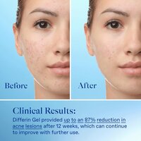 Differin Acne Treatment Gel, 90 Day Supply, 0.1% Adapalene, 45g Pump