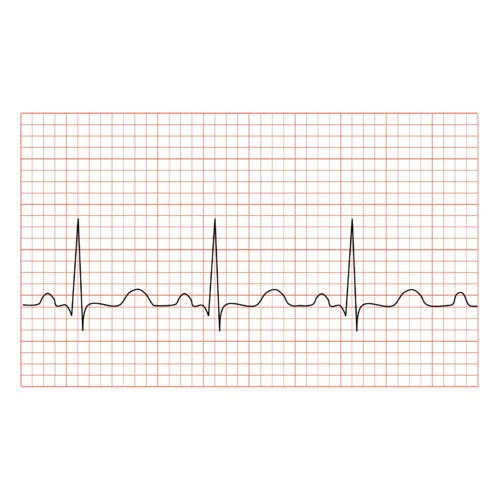 ECG Paper HD