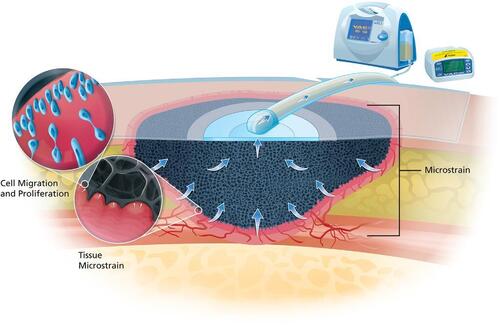 Negative pressure wound therapy