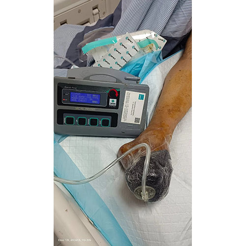 NPWT PORTABLE DEVICE NEGATIVE PRESSURE WOUND THERAPY