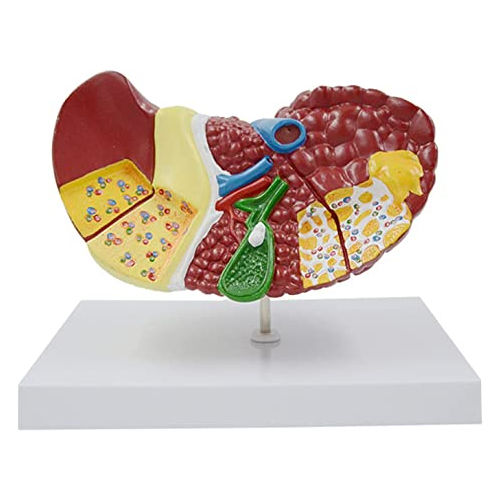 Human Liver Anatomical Model Liver Damage Model - Color: Natural