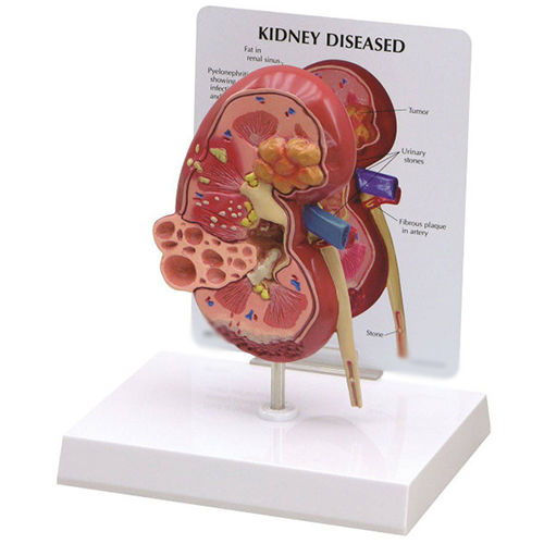 Diseased Kidney Anatomy Model - Color: Natural