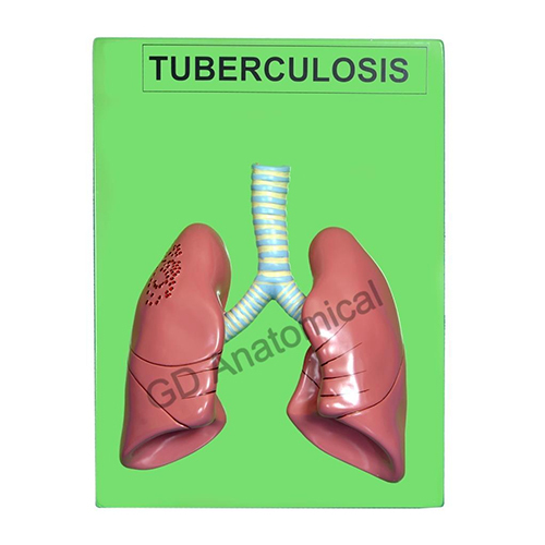 Tuberculosis Model