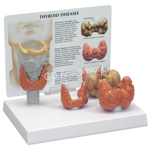 Thyroid Disease Model