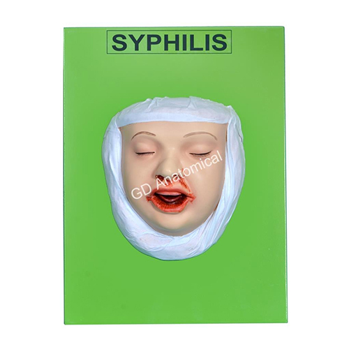 Syphilis Model