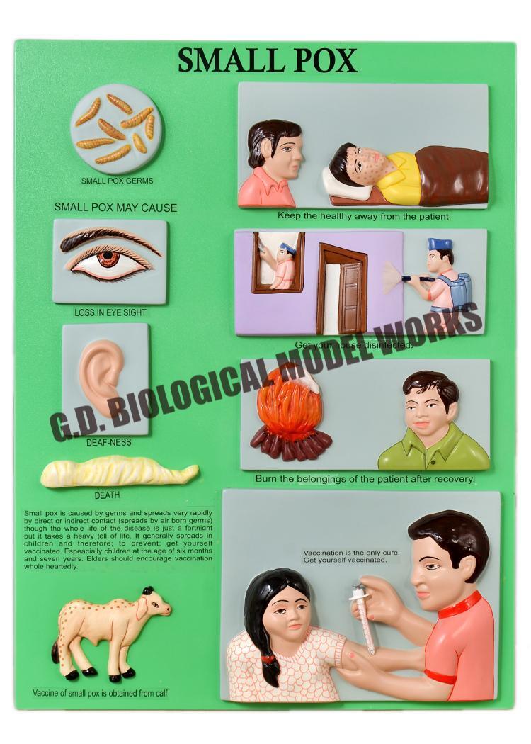 Small Pox Model - Durable Pvc Material | Natural Color, Standard Style For Adult Education