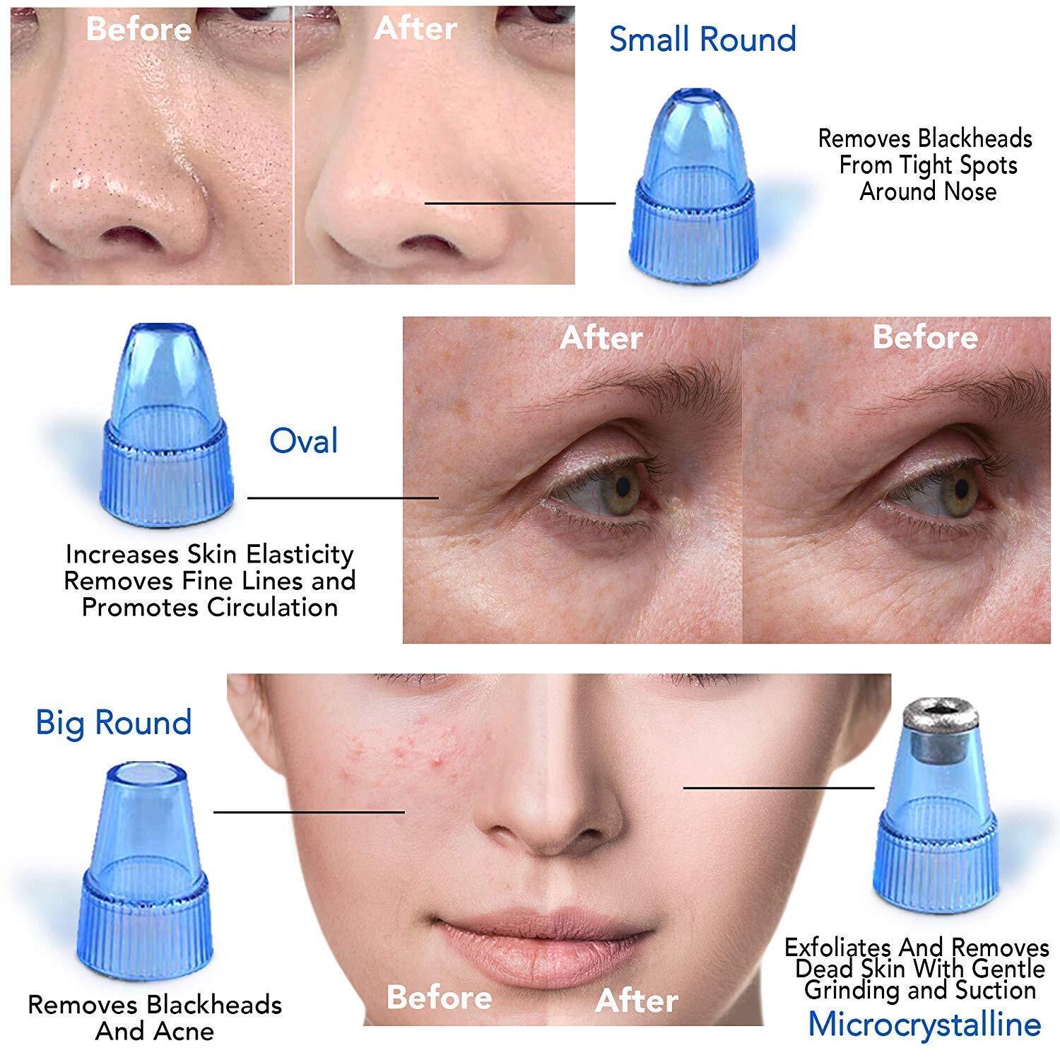 Derma Suction - Blackhead Remover