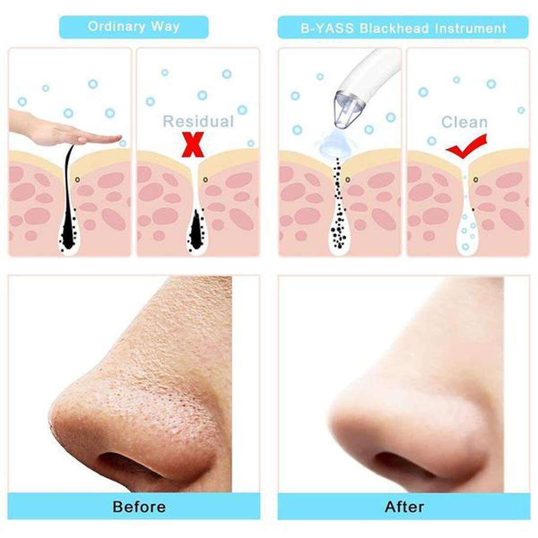 Derma Suction - Blackhead Remover