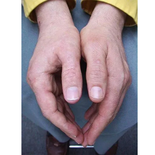Silicone Thumb Prosthesis - Attributes: Safe To Use