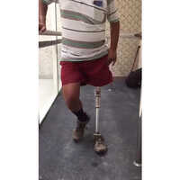 Hip Disarticulation Prosthesis - Carbon Fibre, Straight Design For Leg Amputations, Recyclable Material, Non-flexible Support And Stability