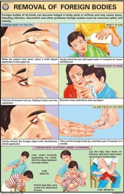 विदेशी निकायों को हटाना चार्ट आयाम: 50 ए 75 सेंटीमीटर (सीएम)