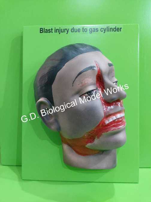 Forensic Model Blast Injury Due to Gas Cylinder