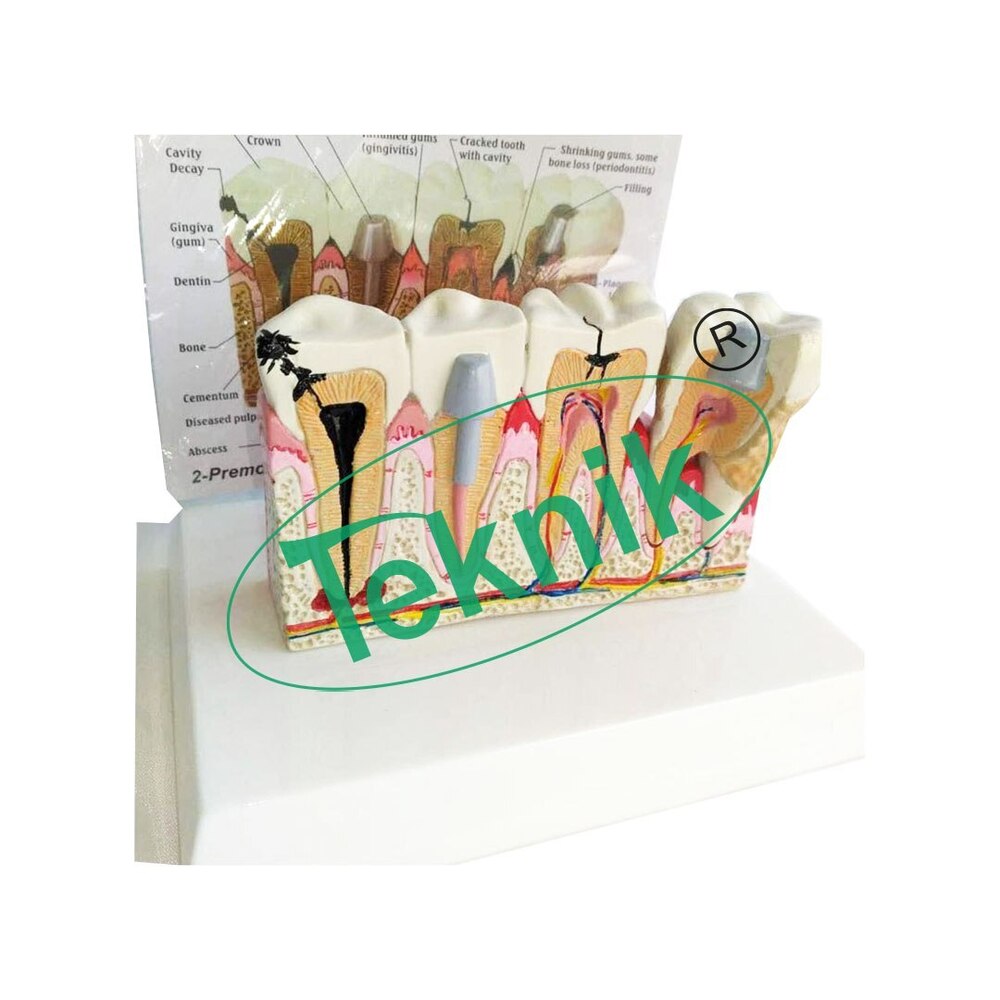 Tooth Models - Detailed 2-part Lower Incisor & Canine, Less Than 1-root Premolar, Less Than 2-root Molar With Caries, 3-part Upper Molar | Ideal For Biology Models