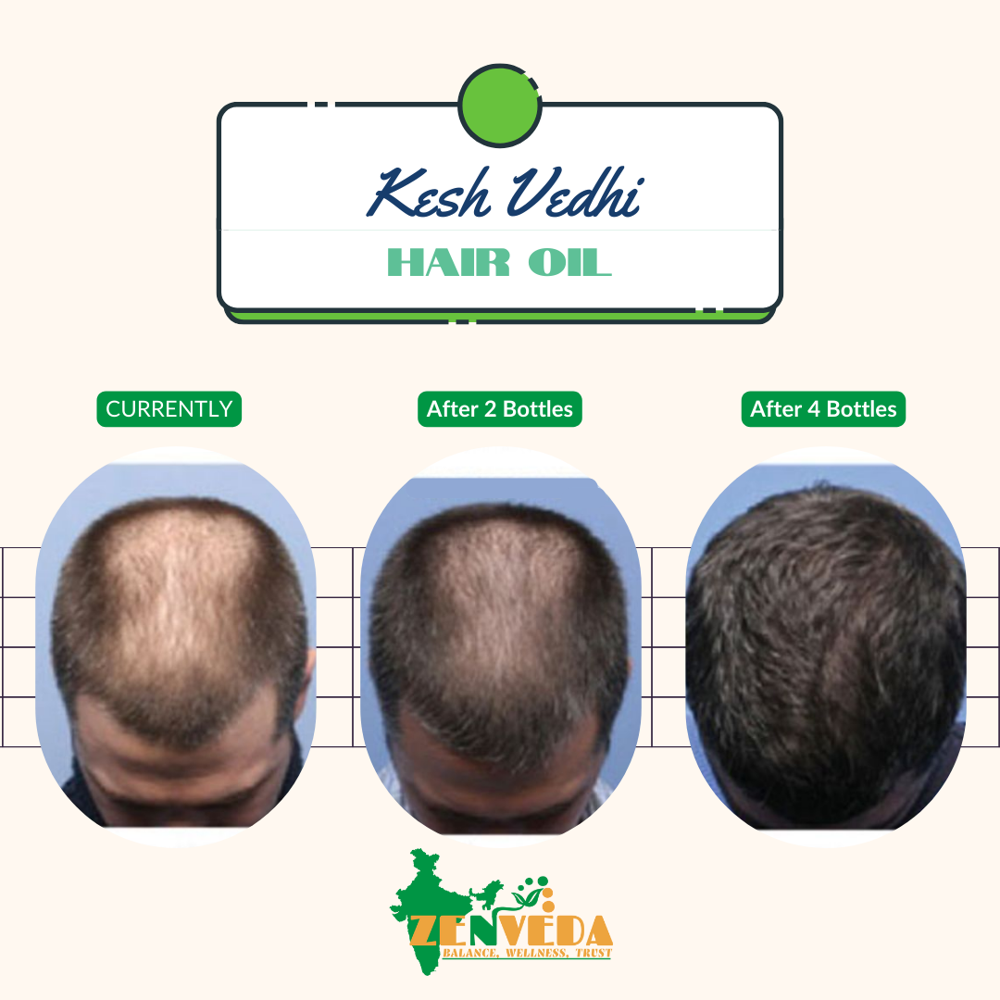 50ml Kesh Vidhi Herbal Regrowth Hair Oil