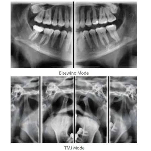 Opg X-ray Machine - Application: Hospital