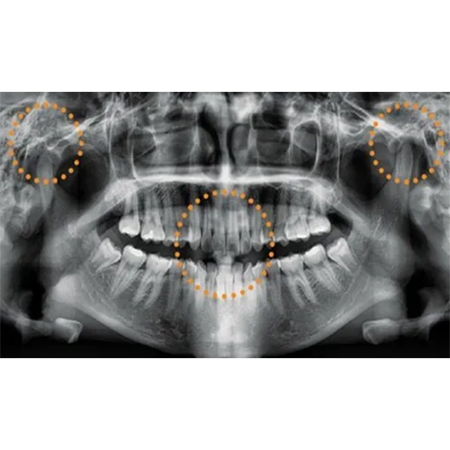 Opg X-ray Machine - Application: Hospital