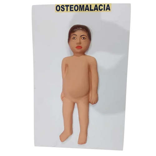 Osteomalacia Forensic Model