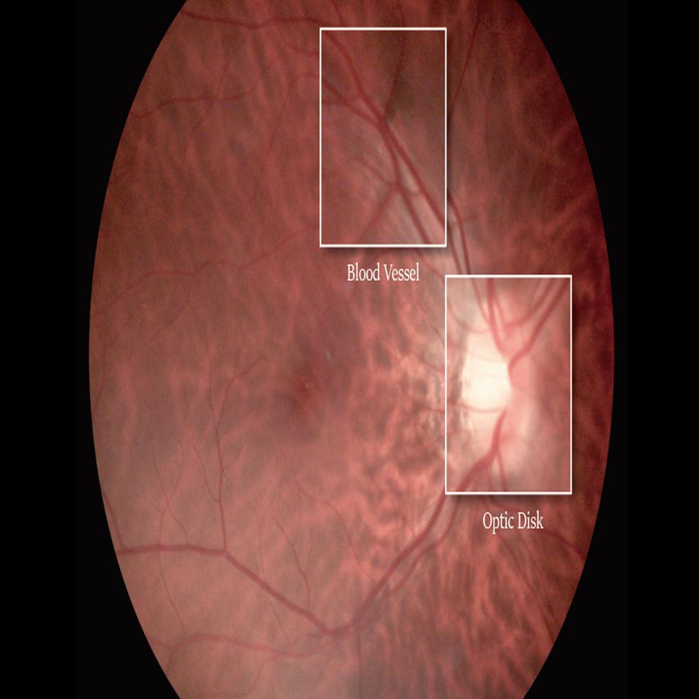 Mediworks Portable Fundus Camera FC 161