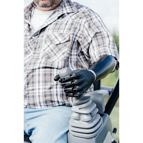 Below Elbow Bionic Hand